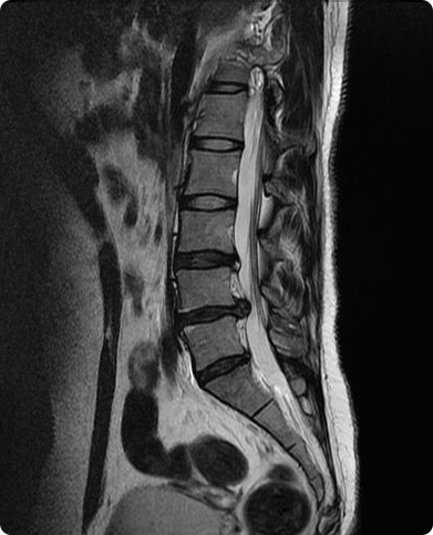 PSLD 수술 전 MRI
