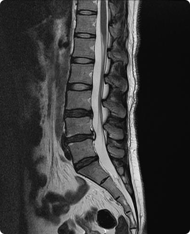 풍선성형술 시술 후 : 골시멘트가 충전된 X-RAY
