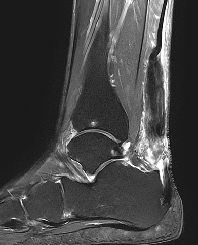 아킬레스건 파열 수술 전 : 아킬레스건 파열이 확인되는 MRI 또는 초음파