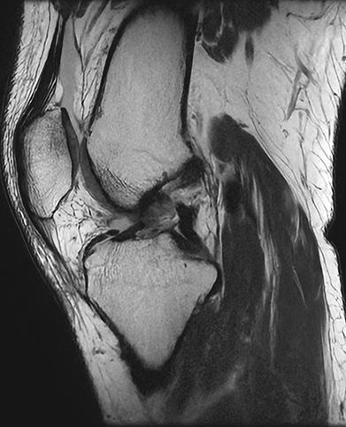 전방십자인대 파열 수술 전 : 전방십자인대 파열이 확인되는 MRI
