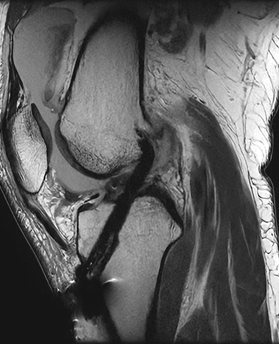 전방십자인대 파열 수술 후 : 골 터널과 고정장치가 확인되는 무릎 X-RAY